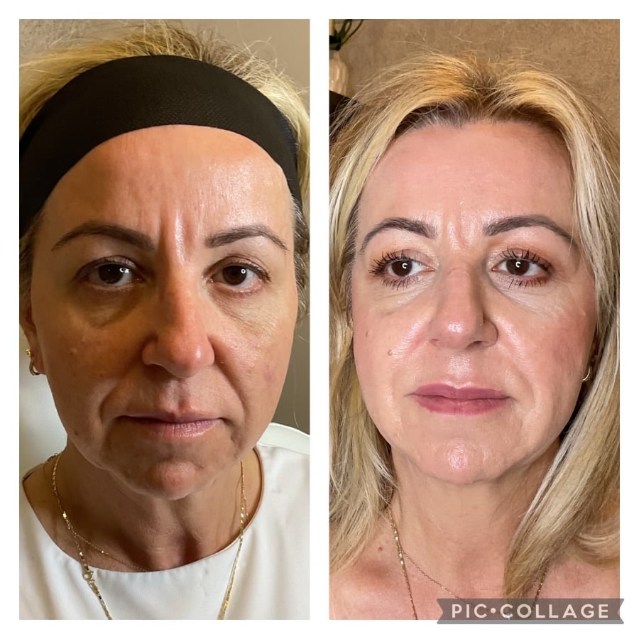 NFuze patient result, front view before and after treatment