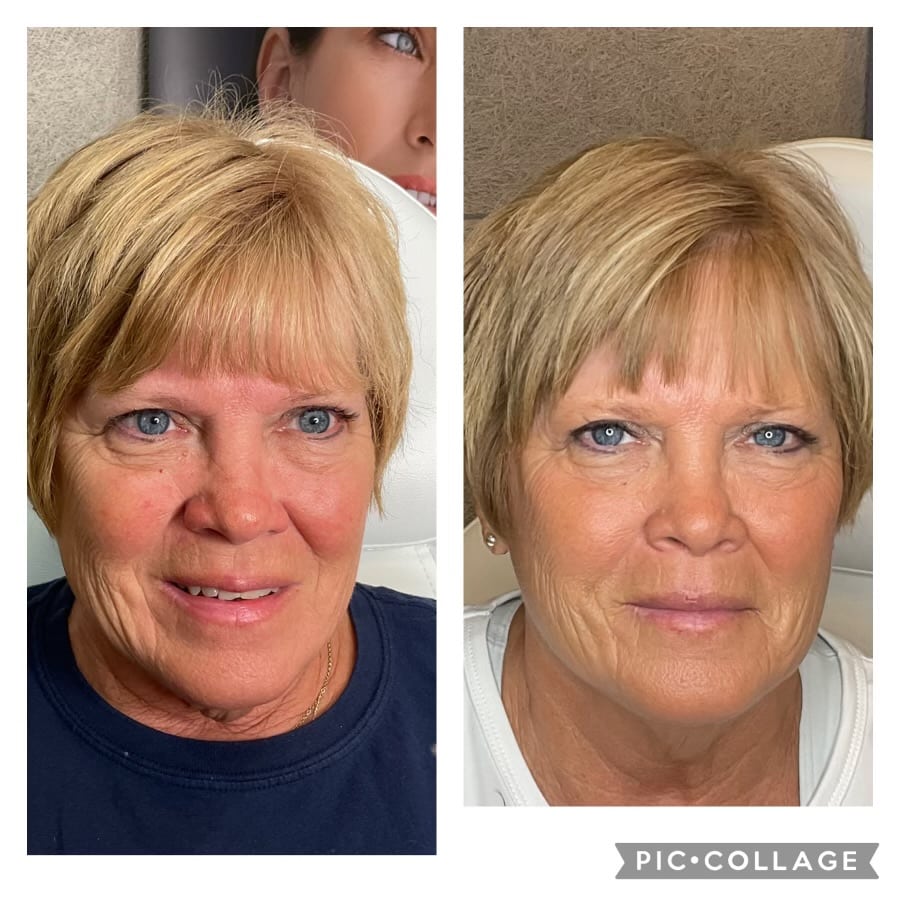 NFuze patient result, front view before and after treatment