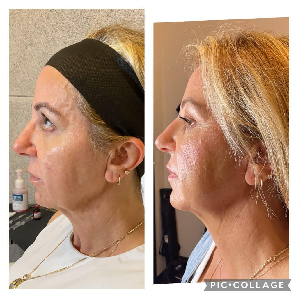 NFuze patient result, profile view before and after treatment