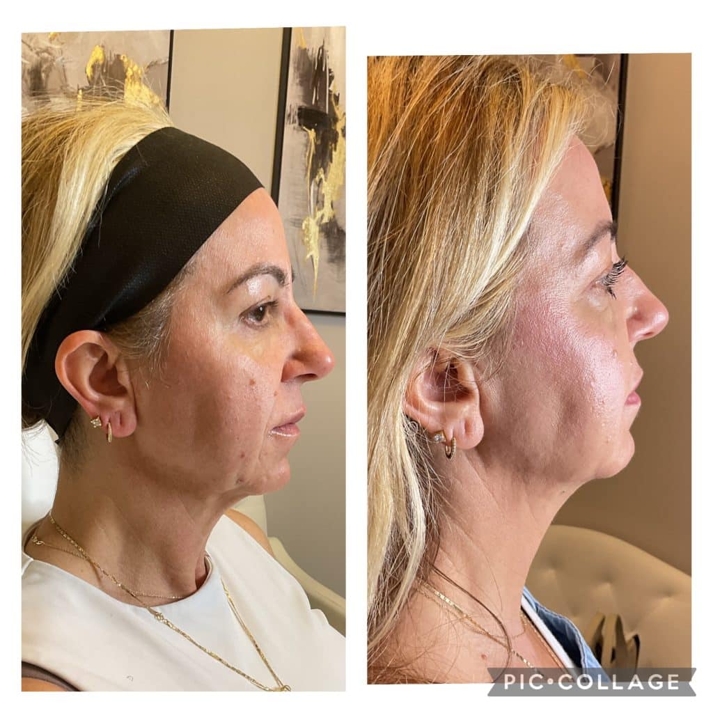 NFuze patient result, profile view before and after treatment