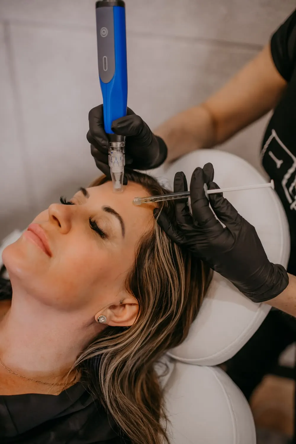 Microneedling with PRP at NFuze Wellness