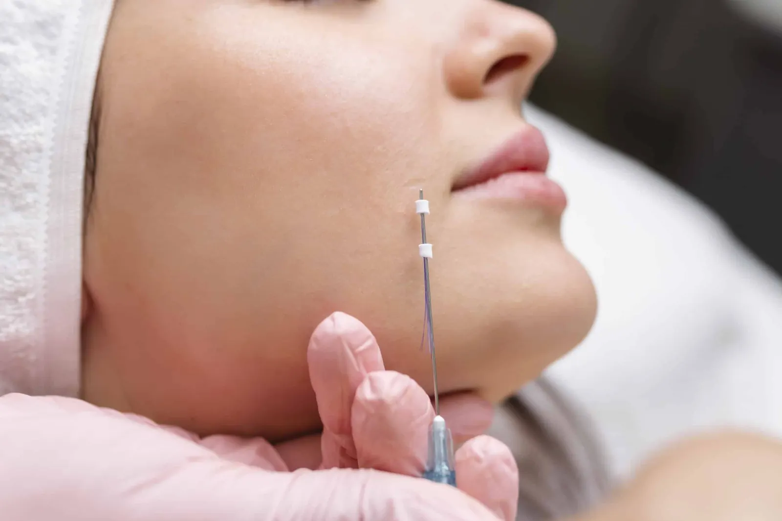 PDO Thread Lifts treatment at NFuze Wellness